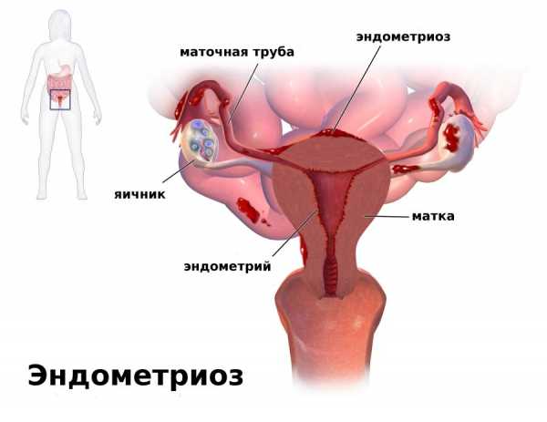 При эндометриозе прогестерон
