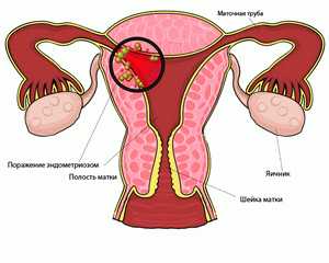 Причины возникновения эндометриоза