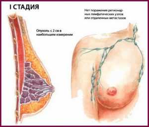 Рак молочной железы 1 стадия прогноз выживаемости после операции