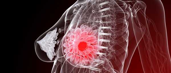 Рак молочной железы агрессивный