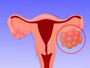 Рак яичника симптомы у женщин выживаемость