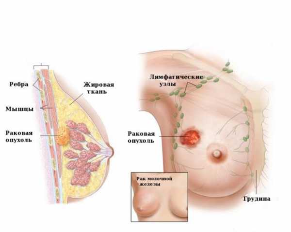 Симптом площадки при раке молочной железы