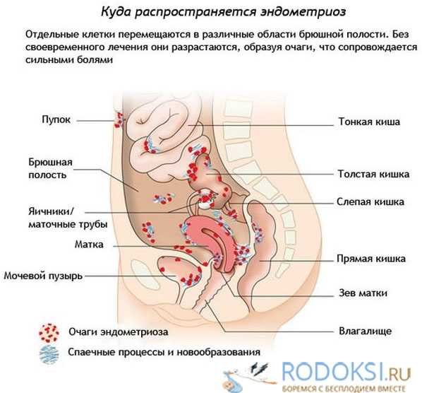 Симптомы эндометриоза кишечника у женщин