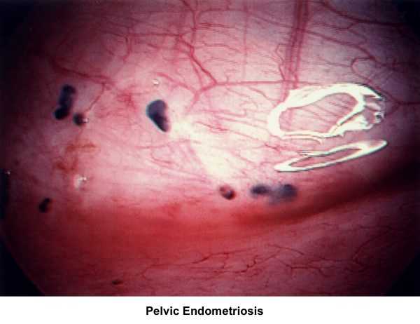 Симптомы эндометриоза у женщин