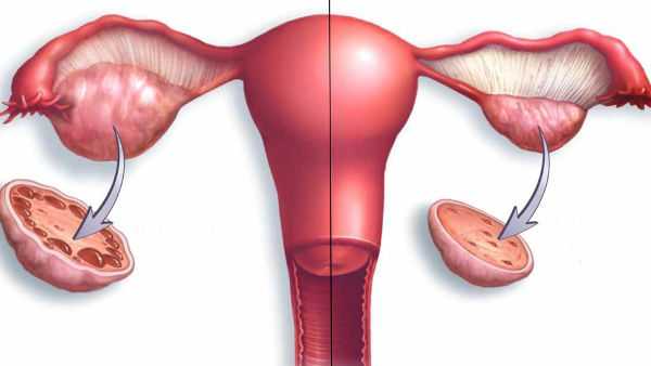 Симптомы поликистоза яичников у женщин