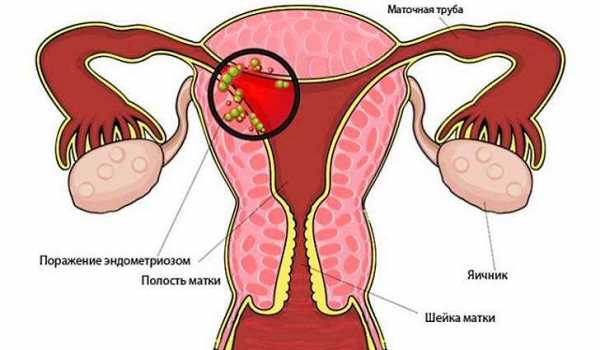 Внутренний эндометриоз тела матки