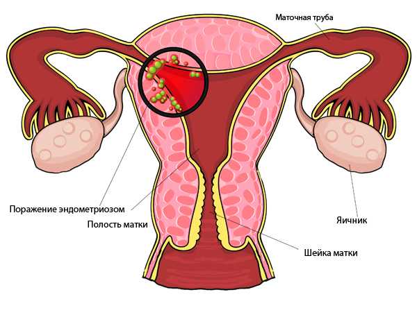 Выделения при эндометриозе