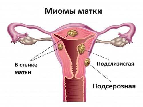 Злокачественная миома матки