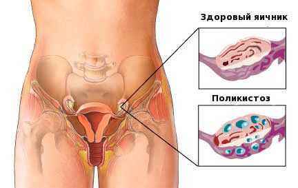 Беременность при поликистозе яичников