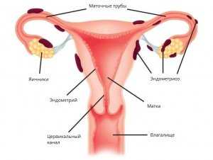 Чем опасен эндометриоз матки если его не лечить