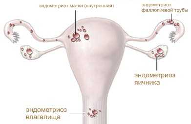 Диагностика эндометриоза