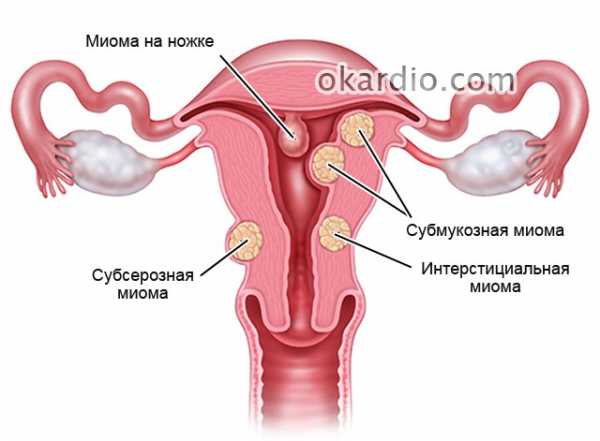 Эмболизация маточных артерий при миоме матки