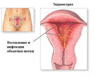 Эндометриоз и эндометрит