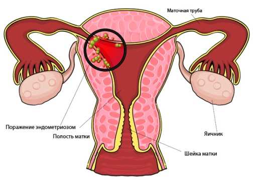 Эндометриоз матки симптомы и причины