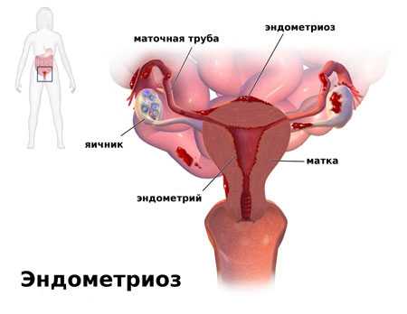 Эндометриоз перитонеальный