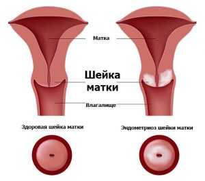 Эндометриоз шейки матки симптомы и лечение