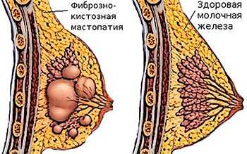 Фиброкистозная мастопатия молочной железы лечение