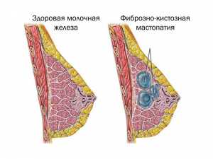 Фиброзно кистозная мастопатия симптомы лечение народными средствами