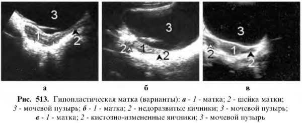 Инволютивные изменения яичников что это. Гипоплазия матки на УЗИ. Гипоплазия эндометрия на УЗИ. Гипоплазия матки УЗИ критерии. Гипоплазия шейка матки.