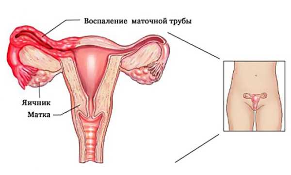 Как лечить воспаление яичников у женщин в домашних