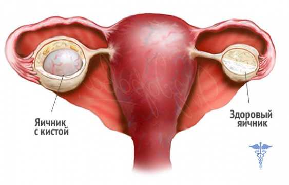 Киста на яичнике лечение и от чего она появилась у женщин