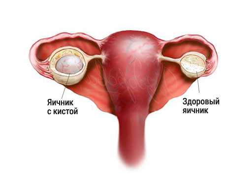 Киста яичника последствия после операции