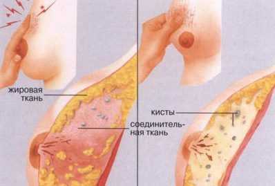 Кистозная мастопатия молочной железы