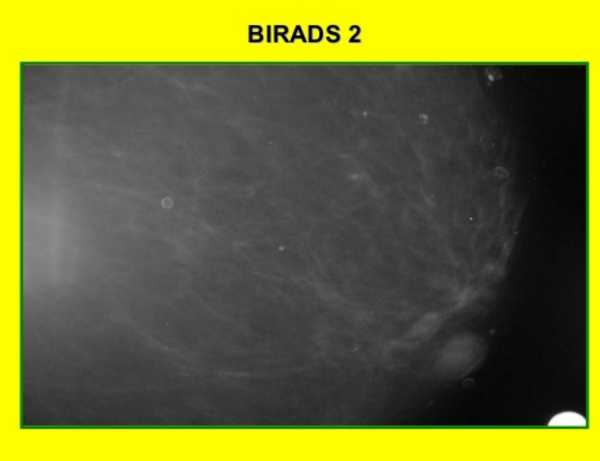 Birads 2 что означает. Bi rads молочная железа. Молочная железа фиброаденома bi-rads 2. Фиброзно кистозная мастопатия молочной железы bi-rads-4a. УЗИ молочных желез бирадс.