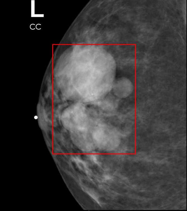 Bi rads 2 acr 2. Фиброзно кистозная мастопатия маммограмма. Bi-rads 3 молочной железы маммограмма.