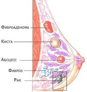 Мастопатия это рак молочной железы