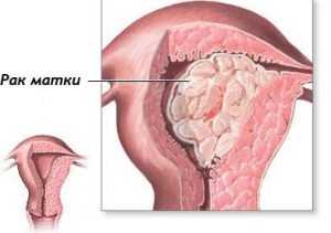 Признаки рака матки и яичников на ранних стадиях