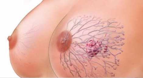 Рак молочной железы как начинается
