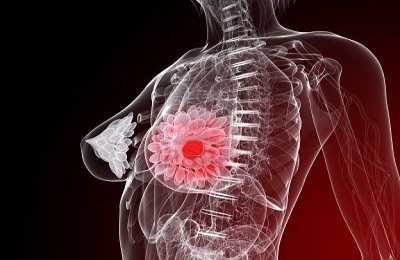 Удаление опухоли молочной железы у женщин