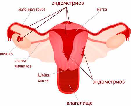 Заболевание гинекологическое эндометриоз