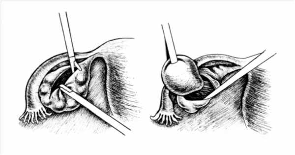 Вылущивание кисты яичника что это